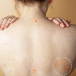 Skin Lesions From Sun Exposure