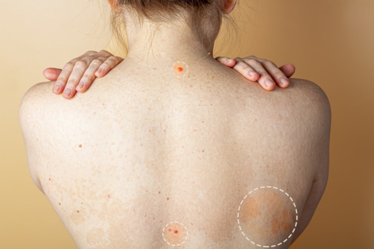 Skin Lesions From Sun Exposure