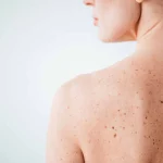 Skin Lesions From Sun Exposure