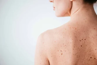 Skin Lesions From Sun Exposure