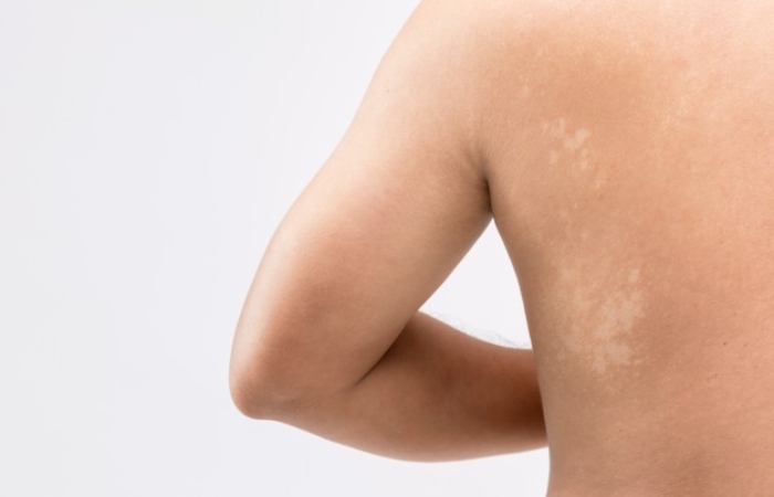 Consequences Of Atopic Dermatitis
