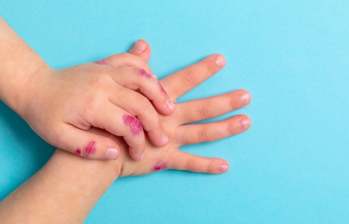 Dermatitis In Children, Those Who Suffer The Most