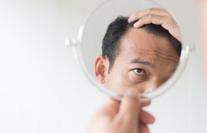 Fibrosing Alopecia, A Mystery To Be Solved