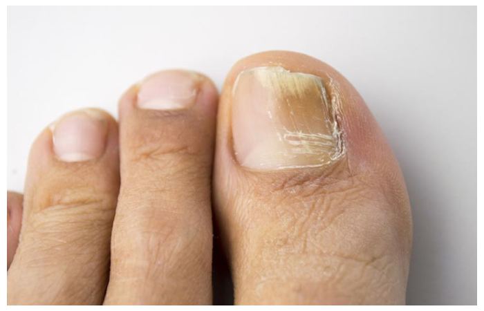 Nail fungus 