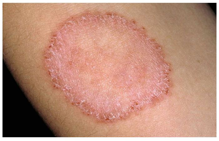 How to Identify and Treat Ringworm on a Tattoo - wide 8