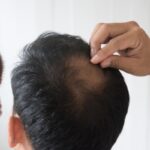 Men's Hairs: Treatments For Hair Loss - Health Cares World