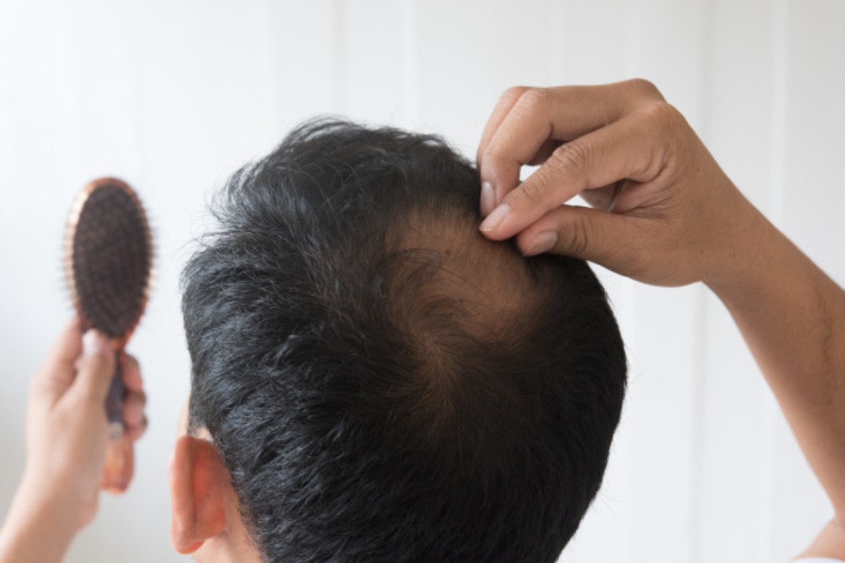 Men's Hairs: Treatments For Hair Loss - Health Cares World