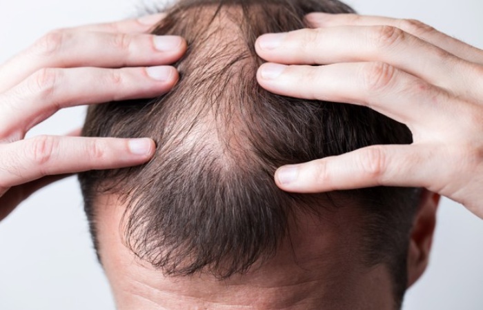 What Are The Main Treatments For Hair Loss_