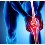 Osteoarthritis