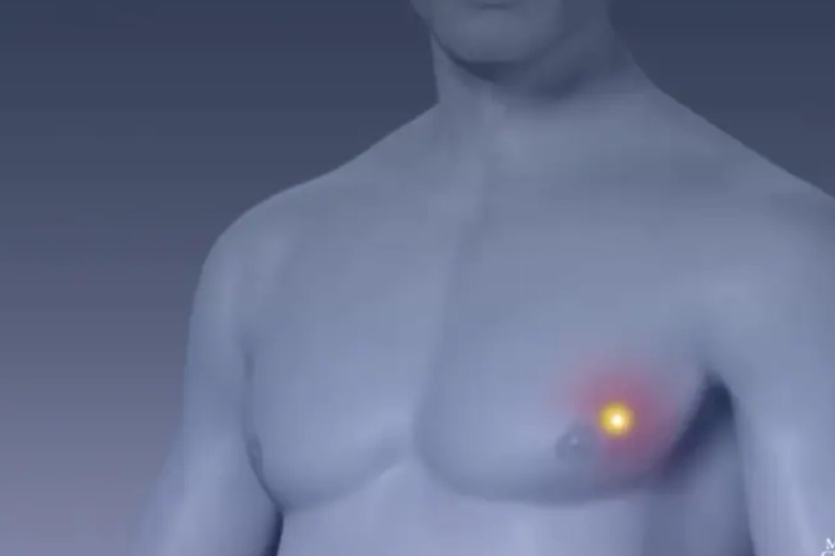 Breast Cancer In Men