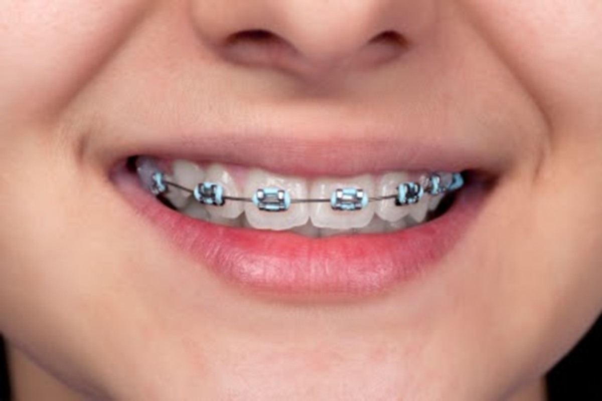 Braces