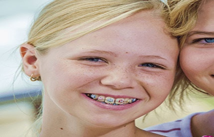options for braces