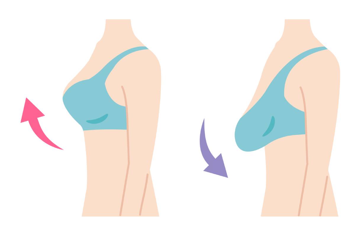 Breast Lift