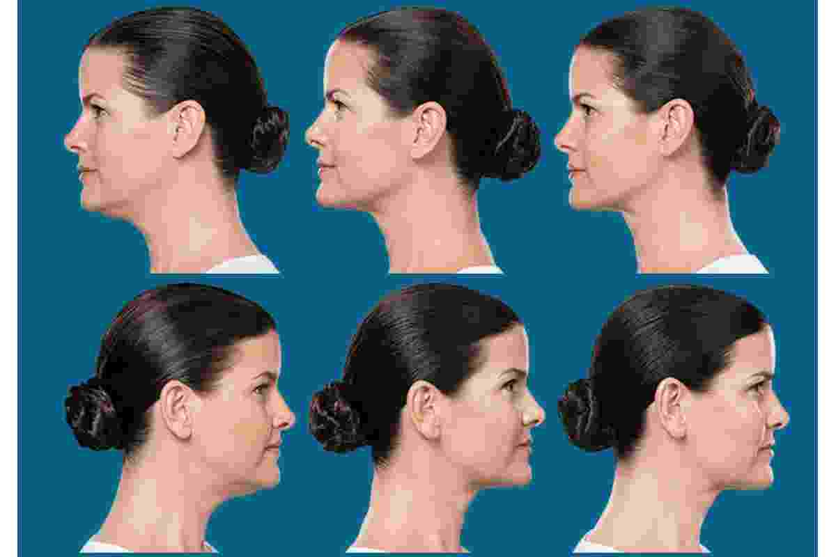 Kybella Treatments