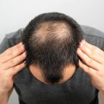 Say Goodbye to Baldness 4 Techniques for Achieving Luscious Hair Growth