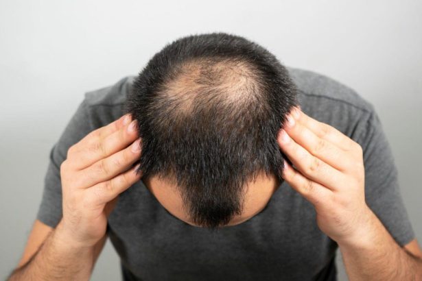 Say Goodbye to Baldness 4 Techniques for Achieving Luscious Hair Growth