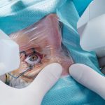 Modern Cataract surgery