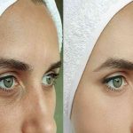 Elevate Your Beauty: The Vertical Facelift Method in Beverly Hills, CA