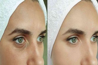 Elevate Your Beauty: The Vertical Facelift Method in Beverly Hills, CA