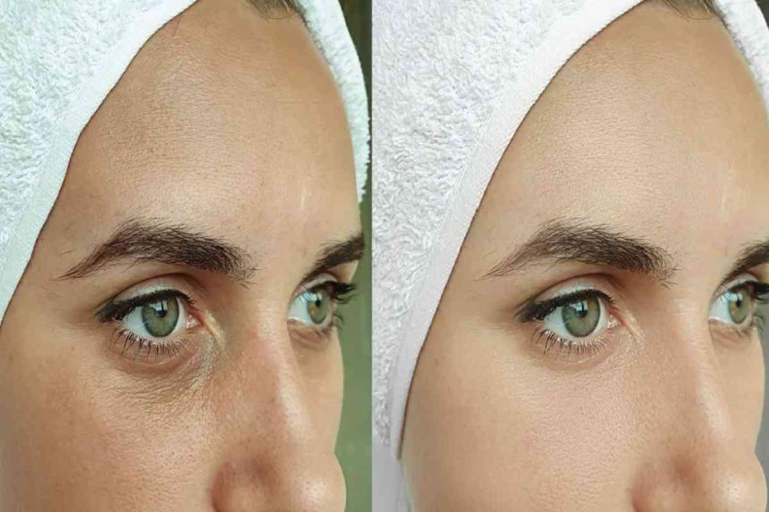 Elevate Your Beauty: The Vertical Facelift Method in Beverly Hills, CA