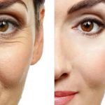 How Soon After Getting Botox Do You See Results?