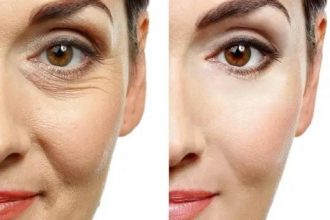 How Soon After Getting Botox Do You See Results?