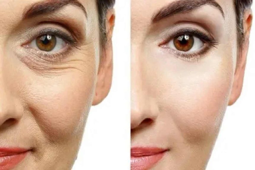 How Soon After Getting Botox Do You See Results?