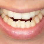 Your teeth moved back. Now what?