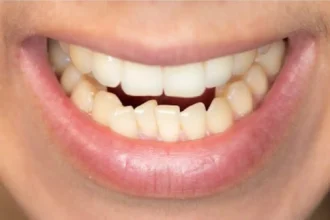 Your teeth moved back. Now what?
